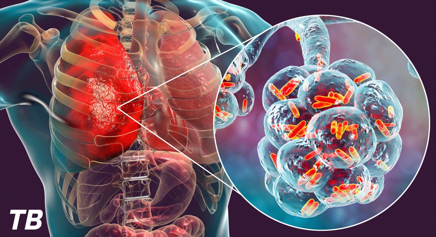 Tuberculosis & Mycobacterial Lung Disease
